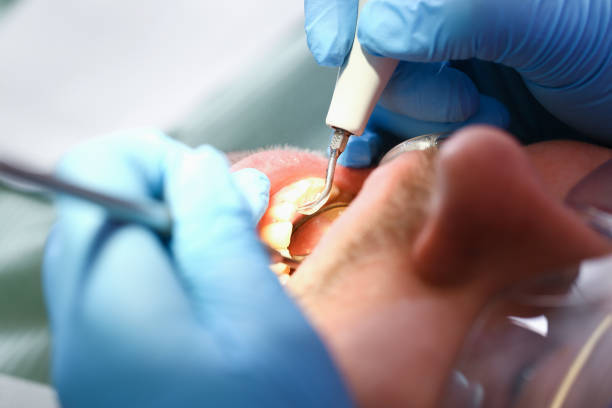 Best Emergency Dental Care for Broken or Chipped Teeth in Lindenhurst, NY
